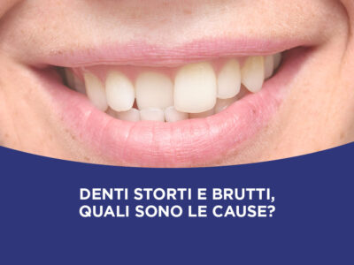 Denti storti e brutti, quali sono le cause