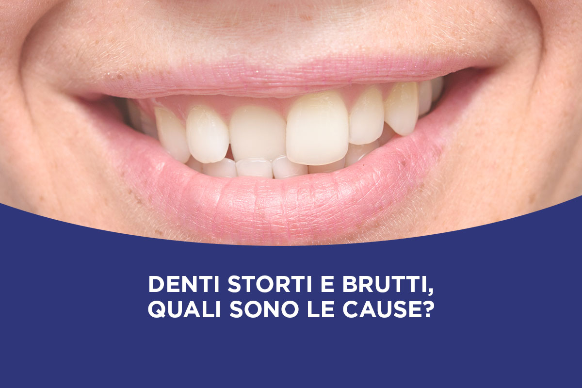 Denti storti e brutti, quali sono le cause