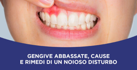Gengive abbassate cause e rimedi