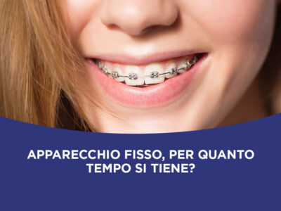 apparecchio fisso per quanto tempo si tiene