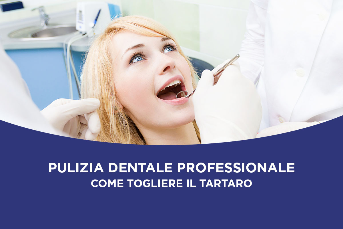 Pulizia dentale professionale: come togliere il tartaro